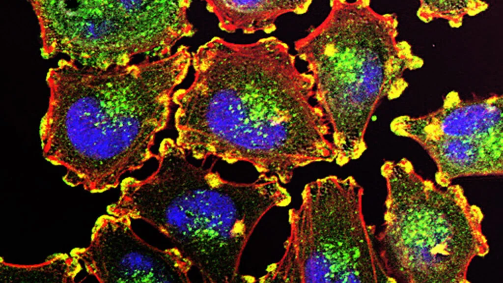 What One Patient’s Melanoma Trial Experience Can—and Can’t—Show About an mRNA Cancer Vaccine