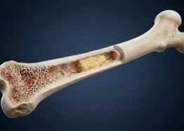 STING Pathway Study Links Aging Marrow Fat to Bone Loss in Mice